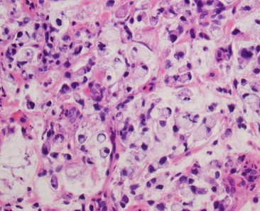 Diagnostic Dilemma: Pulmonary Lymphangiocarcinomatosis as a Manifestation of Occult Signet Ring Cell...