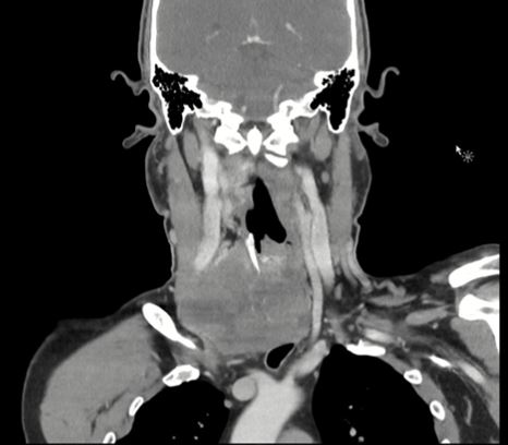 Thyroid Sarcoma: Case Report, Critical Literature Review, and Recent Advances