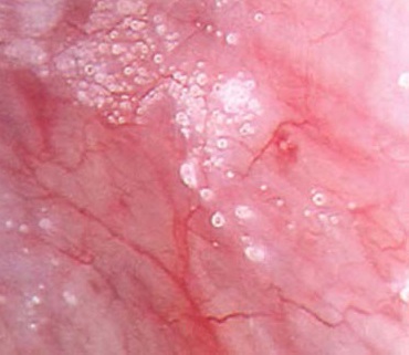 Endosalpingiosis in a Young Woman: A Rare Culprit of Nonspecific Abdominal Pain – A Case Report an...