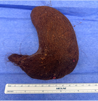 A Tangled Tale: Trichobezoar in a Young Patient with Undiagnosed Celiac Disease