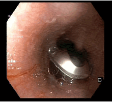 Pill Packet Predicament: Dysphagia as a Complication of Blister Pack Ingestion