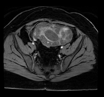 Ewing Sarcoma of the Uterine Cervix: A Case Report and Literature Review