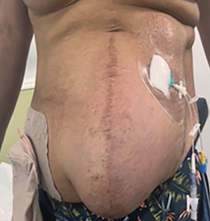 Type IV Parastomal Hernia Repair and Simultaneous Colostomy Closure. Case Report